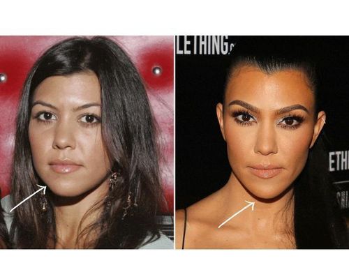 Kourtney Kardashian Plastic Surgery