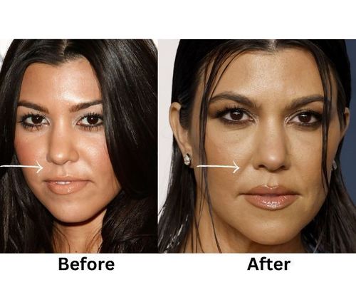 Kourtney Kardashian fillers