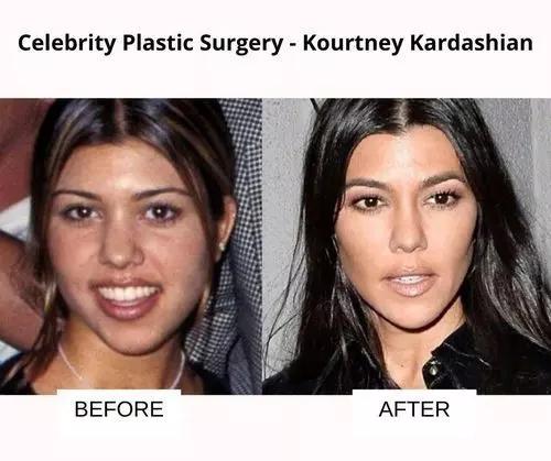 Kourtney_Kardashian_plastic_surgery