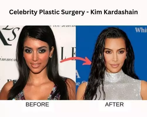 Celebrity Plastic Surgery: 51 Before And After Images