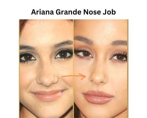 ariana-grande-nose-job