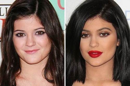 Kylie-Jenner-nose-job-before-and-after