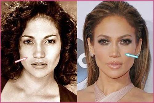 Jennifer-Lopez-nose-job-before-and-after