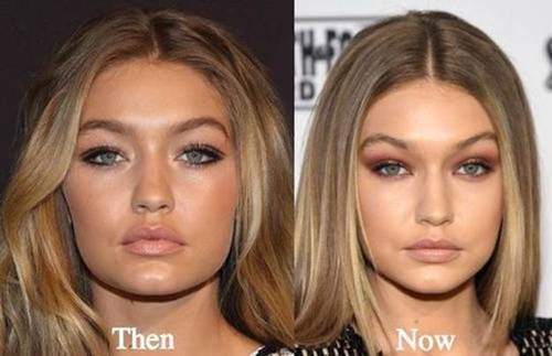 Gigi-Hadid-nose-job-before-and-after