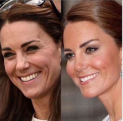 Kate-Middleton-nose-job-before-and-after