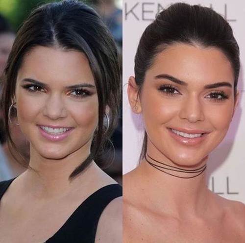 Kendall-Jenner-nose-job-before-and-after