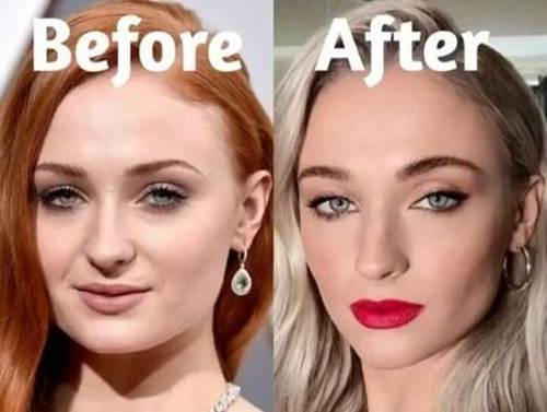 Sophie-Turner-nose-job-before-and-after