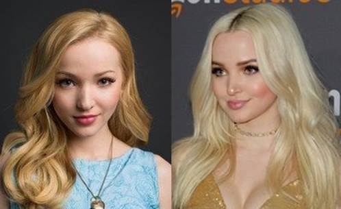 Dove-Cameron-nose-job-before-and-after