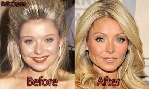 Kelly-Ripa-nose-job-before-and-after