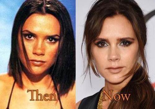 Victoria-beckham-nose-job-before-and-after
