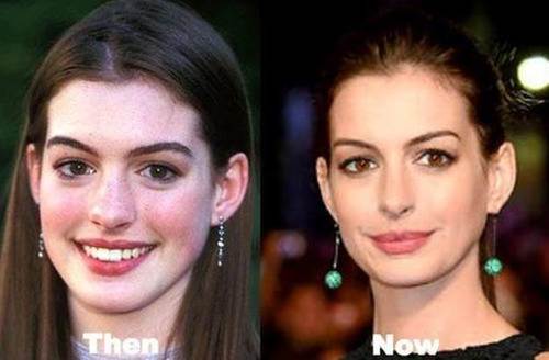 Anne-hathaway-nose-job-before-and-after