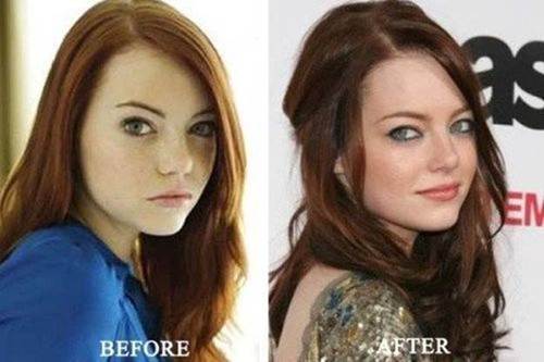 Emma-stone-nose-job-before-and-after