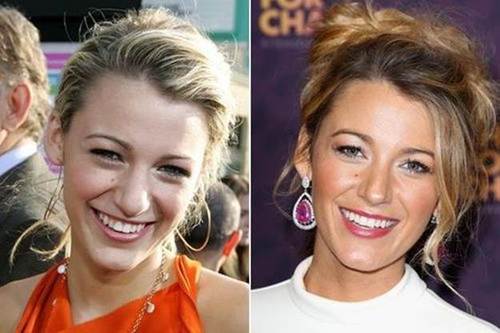 Blake-lively-nose-job-before-and-after