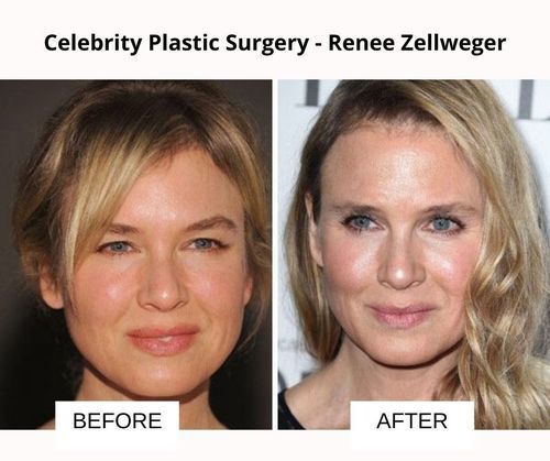 Renee_Zellweger_plastic_surgery