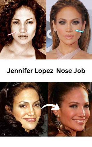 Jennifer Lopez Nose Job