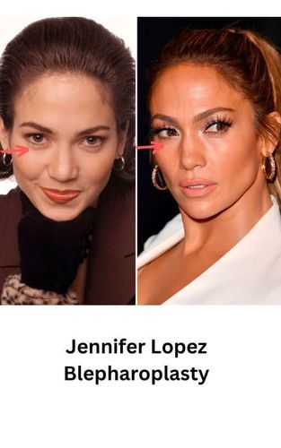 Jennifer Lopez Blepharoplasty