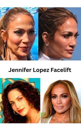 Jennifer Lopez facelift