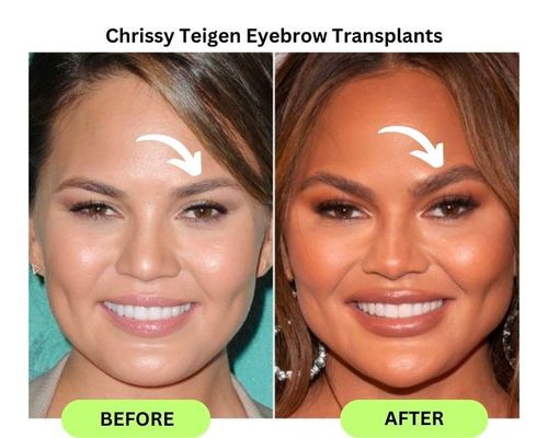 Chrissy Teigen Eyebrow Transplants