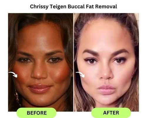 Chrissy Teigen buccal Fat removal