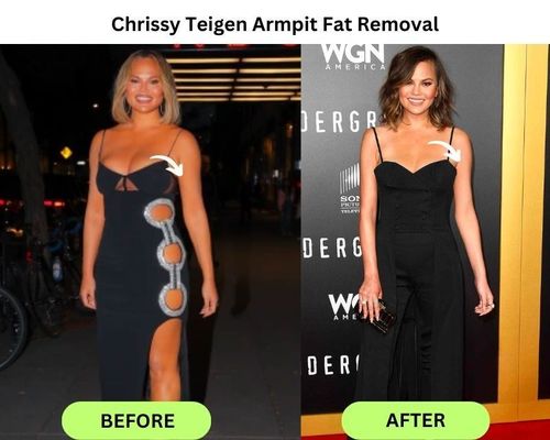 Chrissy Teigen Armpit Fat Removal