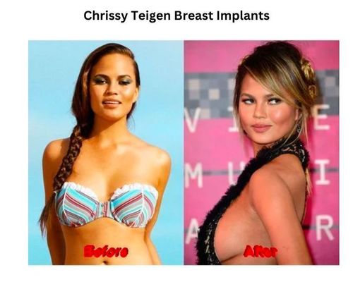 Chrissy Teigen breast implants
