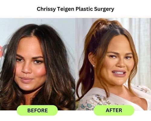 Chrissy Teigen Before and After: Did the Model Get Plastic Surgery?