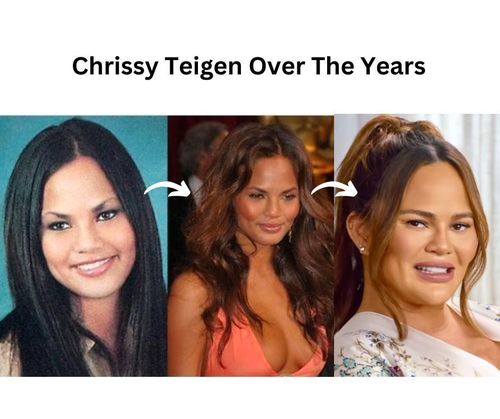 chrissy-teigen-plastic-surgery-changes