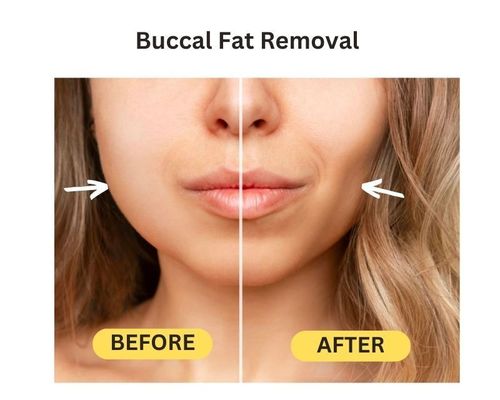 buccal-fat-removal-before-after-