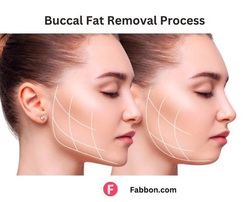 Copy of buccal-fat-process