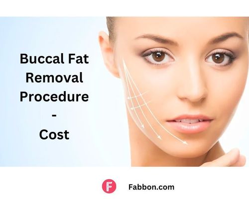 buccal-fat-process-cost