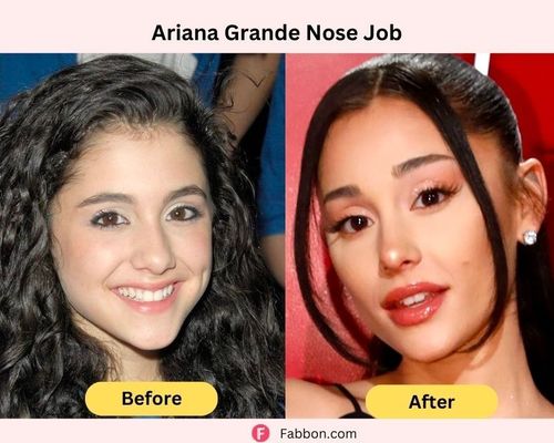 black celebrity nose job before and after