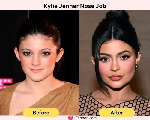 Kylie-jenner-nose-job