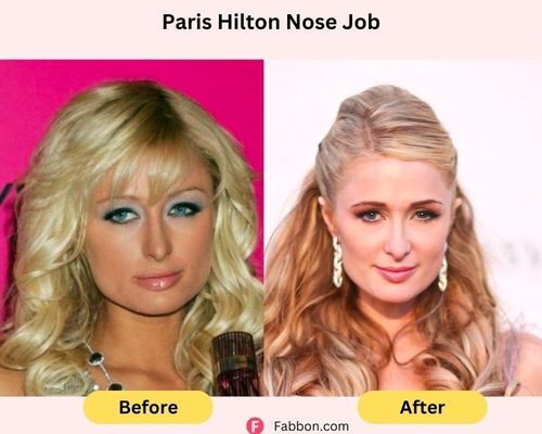 paris-hilton-nose-job