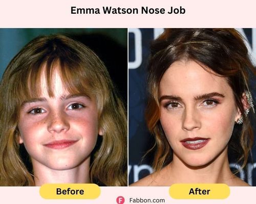 emma-watson-nose-job