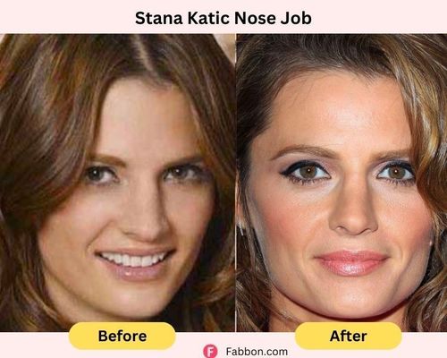 stana-katic-nose-job