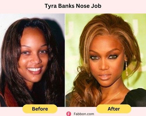 tyra-banks-nose-job