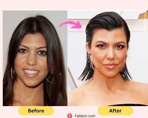 kourtney-kardashian-plastic-surgery