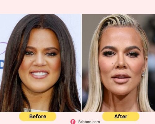 khloe-kardashian-plastic-surgery