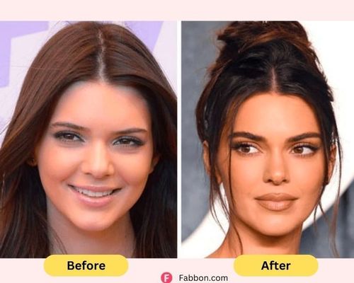 kendall-jenner-plastic-surgery