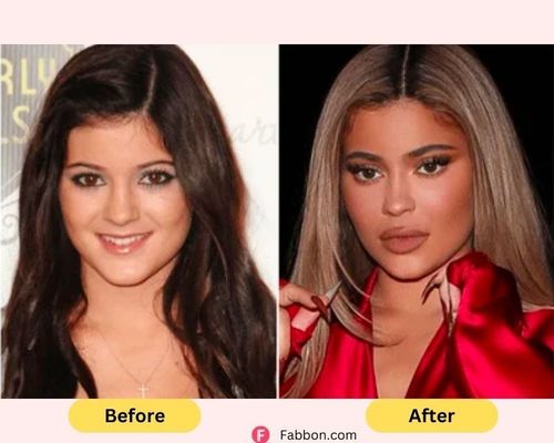 kylie-jenner-plastic-surgery