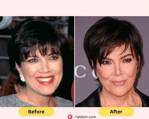 Kardashians Before And After Plastic Surgery Full Guide Fabbon 6232