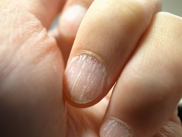 1- Brittle nails