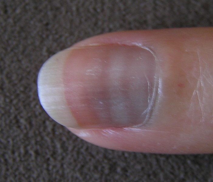 9- Dark lines on nails