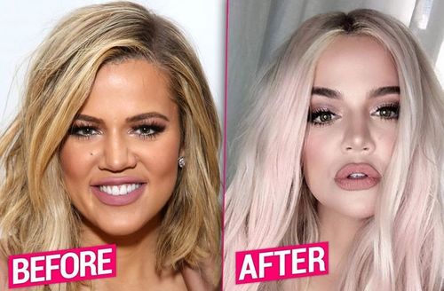 New Year, New Face! Khloe Unrecognizable After Invasive Plastic Surgery Overhaul