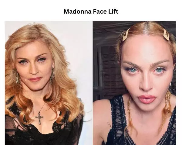 face-lift-madonna-plastic-surgery-before-after