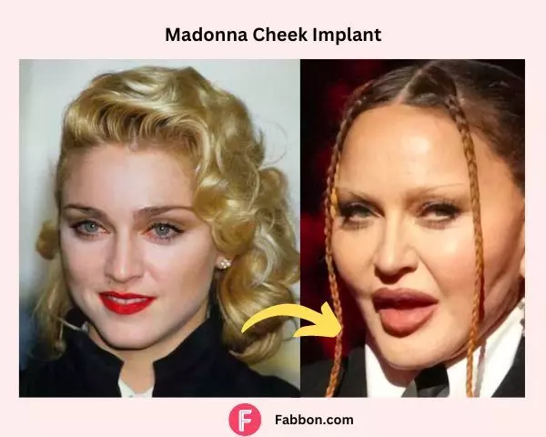 cheek-implant-madonna-plastic-surgery-before-after (1)