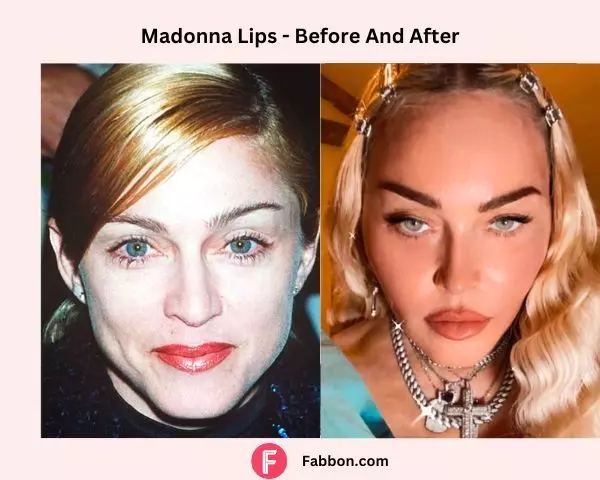 Lips-madonna-plastic-surgery-before-after