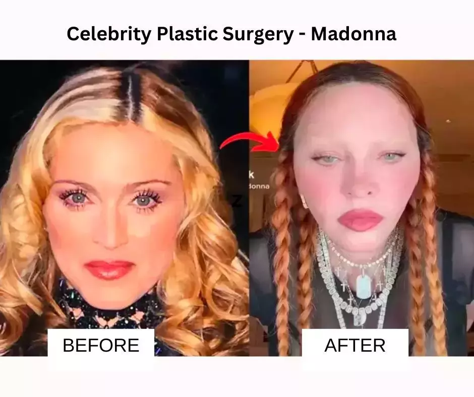 Madonna-plastic-surgery (2)