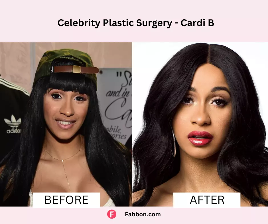 CArdi-B-celebrity-plastic-surgery