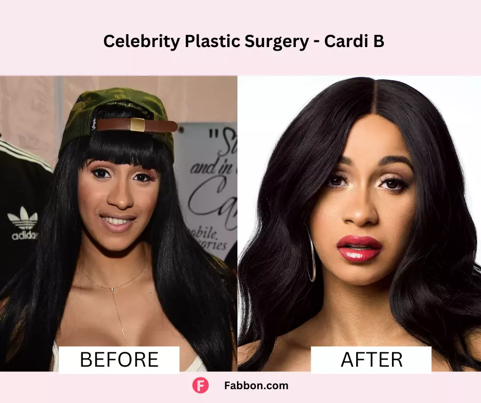 Celebrity Plastic Surgery: 51 Before And After Images | Fabbon